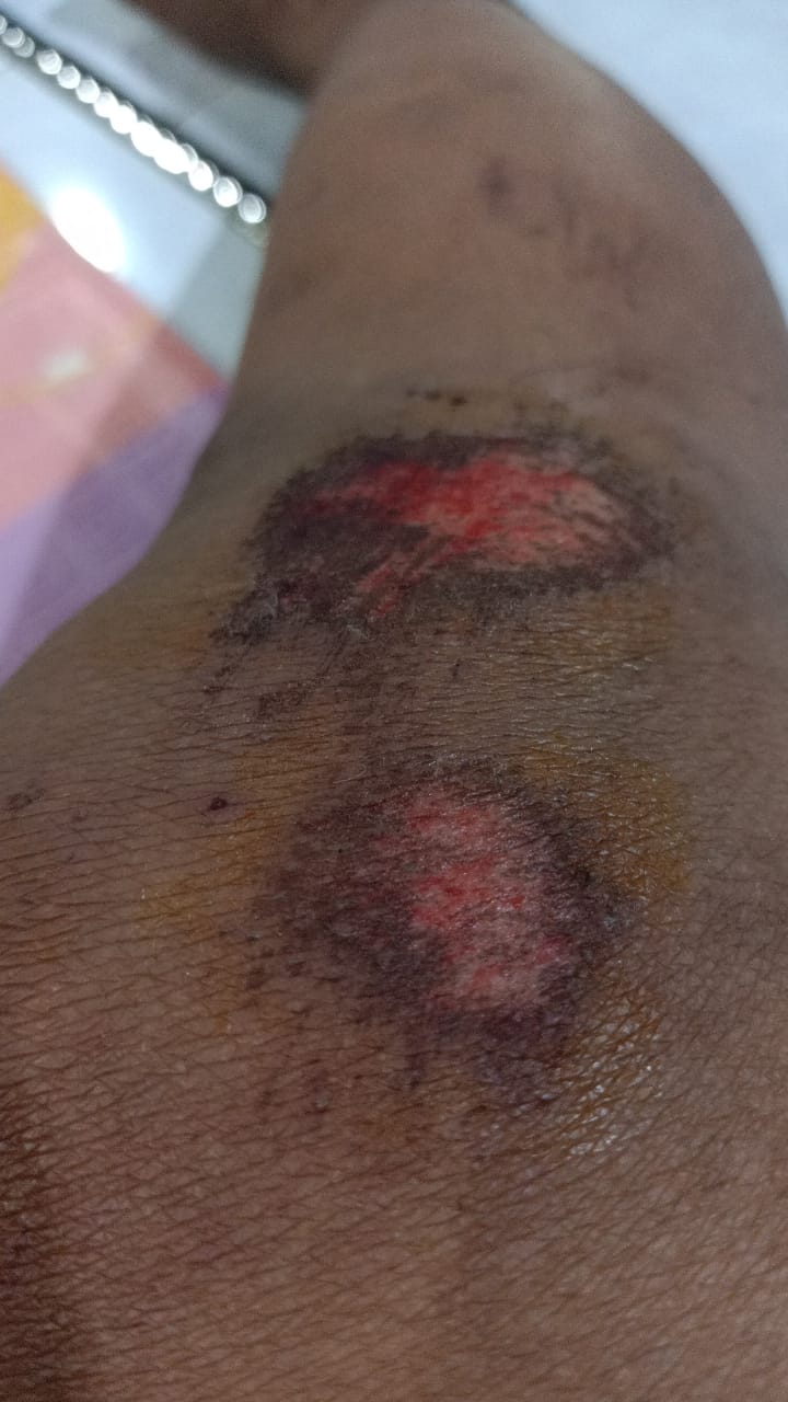 Reporter dan Ketua LSM di Sumenep, tersenggol mobil Box sampai terjatuh, inilah kronologisnya 2 Foto : Faisol menunjukkan lukanya yang tergores jalan Aspal